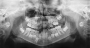 Dental Radiographs (X-Rays) - Pediatric Dentist in Bayside, NY