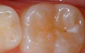 Sealant-Before - Pediatric Dentist in Bayside, NY