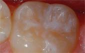 Sealant-After - Pediatric Dentist in Bayside, NY